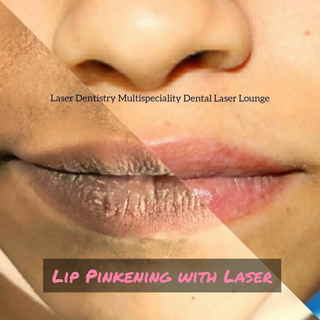 lip pinkening with laser